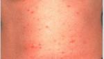 疥癬の症状　Symptom of mange